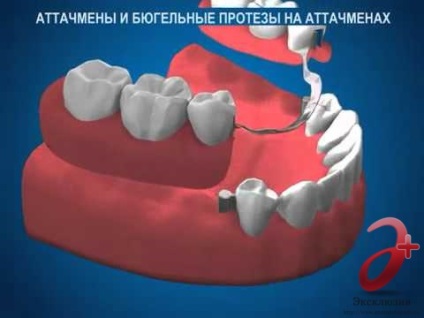 Dispozitiv de prindere pe atașamente în St. Petersburg - instalare, prețuri, recenzii