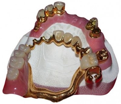 Proteza de prindere a dinților
