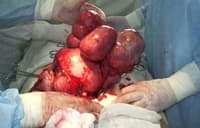 Miomul mai periculos al complicațiilor posibile ale uterului