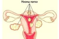 Miomul mai periculos al complicațiilor posibile ale uterului