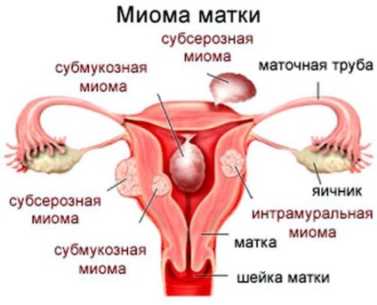 Miomul mai periculos al complicațiilor posibile ale uterului