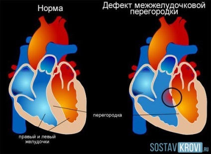 Defectul septului interventricular al inimii provoacă, simptome, diagnostic, complicații