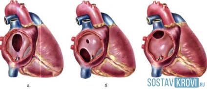 Defectul septului interventricular al inimii provoacă, simptome, diagnostic, complicații