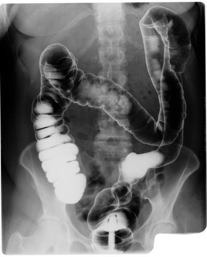 Dolihomegakolon simptome, semne, diagnostic și tratament