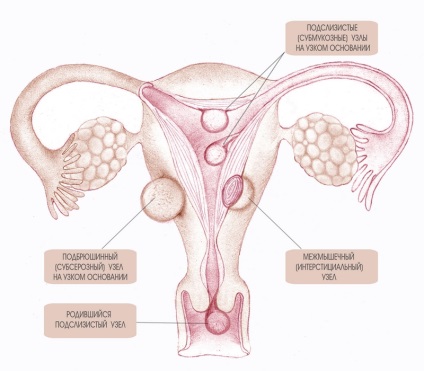 Embolizarea miomului uterin