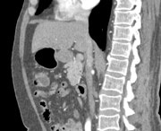 Această prevenire a cancerului intestinal va ajuta să nu se îmbolnăvească