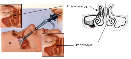 Operația endoscopică funcțională a cavității nazale și sinusurilor paranasale - darius rauba