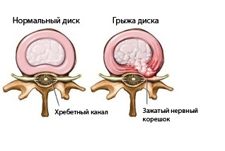 În cazul în care în Yaroslavl pentru a vindeca hernie intervertebral - cabinetul medicului este gros, știri Yaroslavl