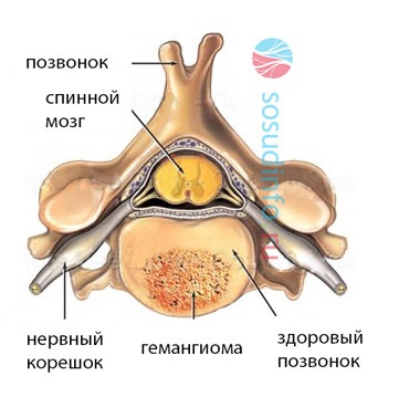 Hemangiomul coloanei vertebrale este ceea ce este și modul în care este tratată
