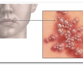 Herpesul de pe buză este contagios pentru copil