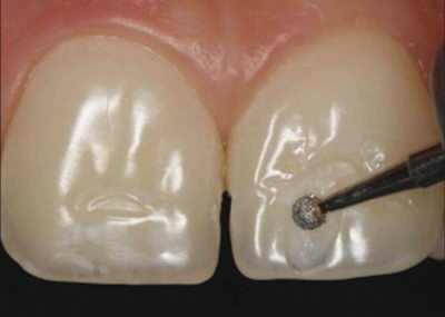 Hipoplazia smalțului dintelui - ce trebuie făcut pentru corectarea mușcăturii și a brațelor