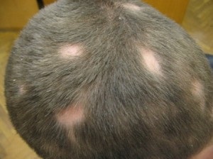 Alopecia alungită în copii - cauze, manifestări și tratament