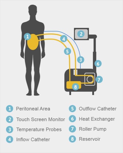 Hot chimioterapie, hipec, chimie fierbinte, centru medical conac, diagnostic modular și tratament în