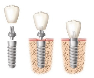 Implantarea dinților Odessa, stomatologie estetică - implantologie axială