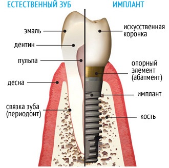 Implantarea dinților, implant dentar - instalare și preț, stomatologie 