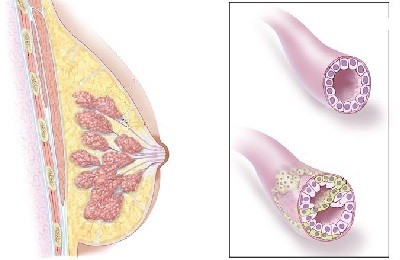 Infiltrarea cancerului mamar la prognosticul de carcinom de gradul 2 și 3