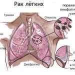 Cum să tratați cancerul pulmonar cu remedii folclorice și medicamente