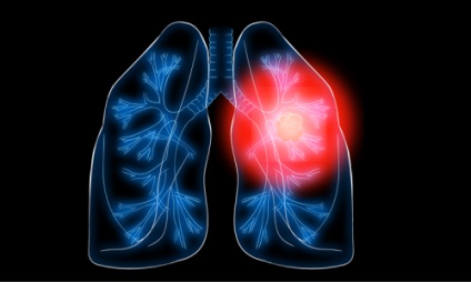 Cum să tratați cancerul pulmonar cu remedii folclorice și medicamente