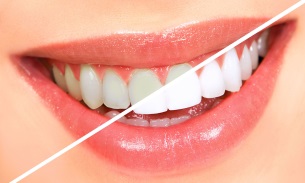 Cum să vă albiți dinții pentru o zi