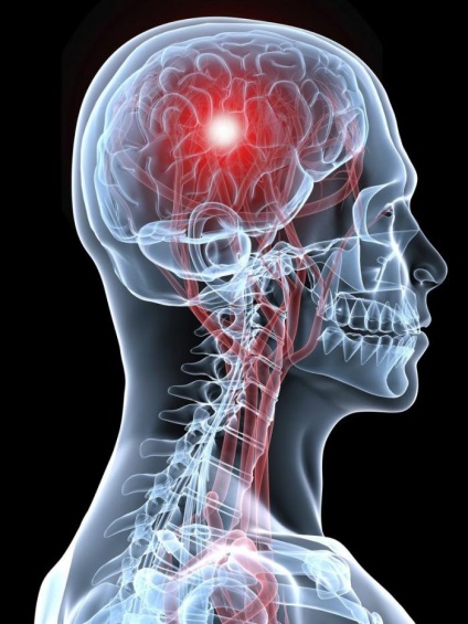 Cum de a recunoaște un accident vascular cerebral în patru moduri simple