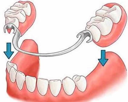 Cum să alegeți protezele amovibile, alegerea protezelor detașabile