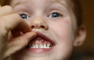 Cum arată chistul pe gingii la un copil