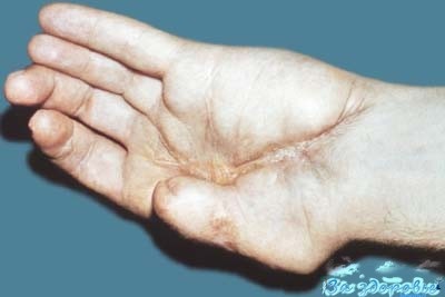 Keratodermia palmelor și tălpilor principalelor cauze, simptome, opțiuni de tratament