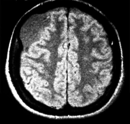 Chistul creierului - este un rezumat al bolii