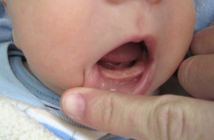 Chistul pe gingiile unui copil pe care părinții trebuie să-l cunoască