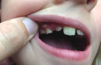 Chistul pe gingiile unui copil pe care părinții trebuie să-l cunoască