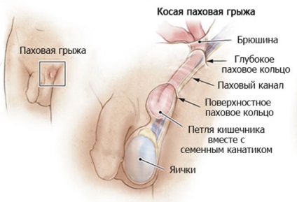 Hernia inghinală inghinală - la bărbați, la femei, simptome, tratament, perioadă postoperatorie