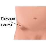 Hernia inghinală inghinală - la bărbați, la femei, simptome, tratament, perioadă postoperatorie