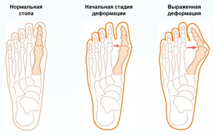 Oasele pe picioare adaptările ortopedice de la un os, anvelope, tratament, totul despre simptomele de guta