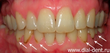 Laser albirea dintilor si restaurarea defectelor dintilor