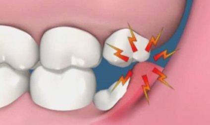 Tratamentul cauzele gingiilor, simptomele și metodele populare de tratament - asistent medical