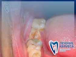 Tratamentul cariei premolarilor, leziunilor carioase ale premolarilor