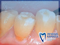 Tratamentul cariei premolarilor, leziunilor carioase ale premolarilor