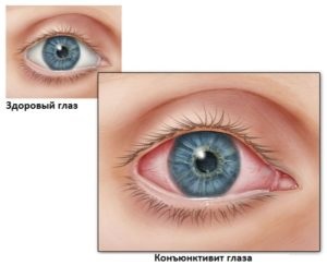Tratamentul conjunctivitei la copii la domiciliu
