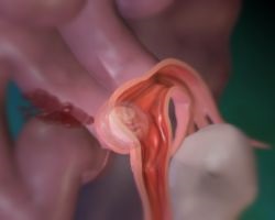 Tratamentul după sarcina ectopică și îndepărtarea tubului, răspunsurile medicilor, consultații