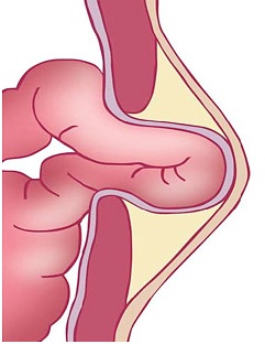 Tratamentul herniei ombilicale