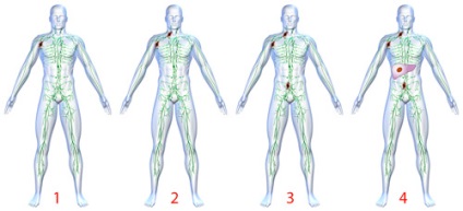 Hodgkin limfóma (limfogranulomatosis) kezelés, tünetek, szakaszok