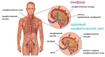 Hodgkin limfóma (limfogranulomatosis) kezelés, tünetek, szakaszok