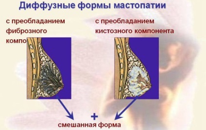 Гърдата на гърдата по време на менопаузата симптоми, признаци и лечение