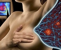 На гърдата по време на симптомите при менопауза и лечение на рак на гърдата при жени в менопауза