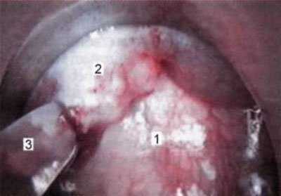 Mediastinoscopia pentru limfoame mediastinale maligne