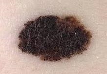 Melanomul - tratament în Germania