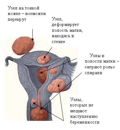 Fibrele uterine - complicații