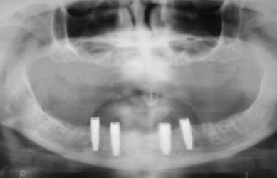 Reabilitarea imediată funcțională ortopedică cu adenit mandibular - implantologie