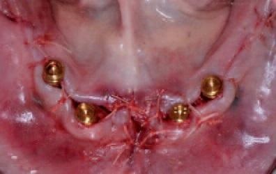 Reabilitarea imediată funcțională ortopedică cu adenit mandibular - implantologie