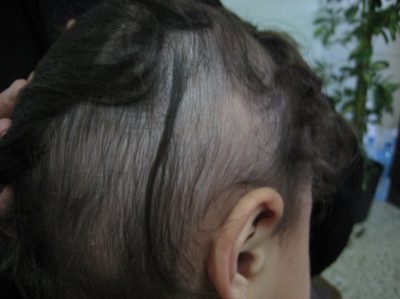 Alopecia areata egy gyermekben és a kopaszság fészkelődésének okai gyermekekben